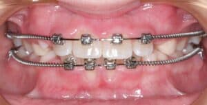 Выравнивание зубов у ребенка фото 3