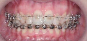 Ранние эластики фото