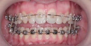 Ранние эластики фото 2