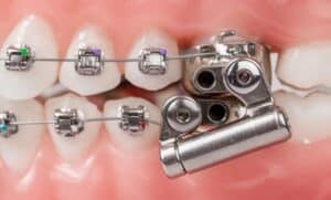 Аппарат AdvanSync фото