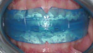 Преортодонтический трейнер фото 2