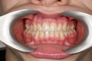 Выравнивание зубов у ребенка фото 4