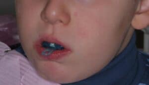 Преортодонтический трейнер фото 3