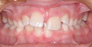 Выравнивание зубов у ребенка фото