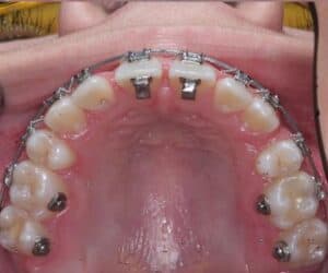 Накусочные брекеты фото