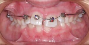 Выравнивание зубов у ребенка фото 2