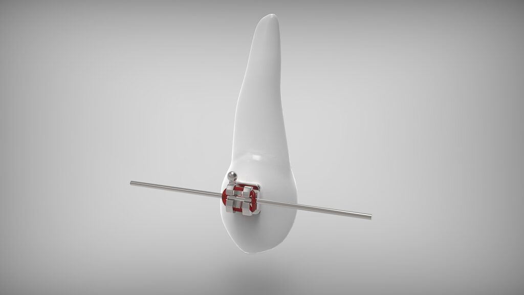 Лингвальные брекеты (Лингвальная брекет-система) фото