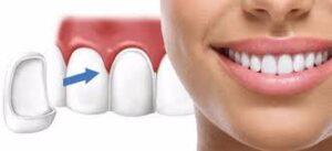 виниры е-макс харьков