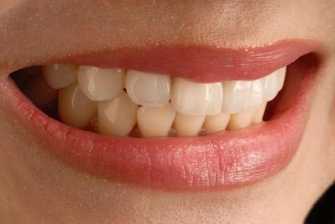 Зубные виниры установка Зубные виниры установка