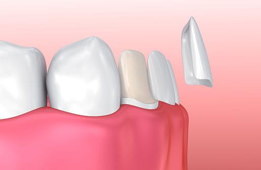 Установка керамических виниров в Харькове