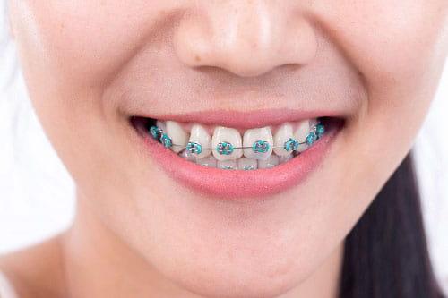 Лигатурные брекет-системы в Харькове Лигатурные брекет-системы в Харькове