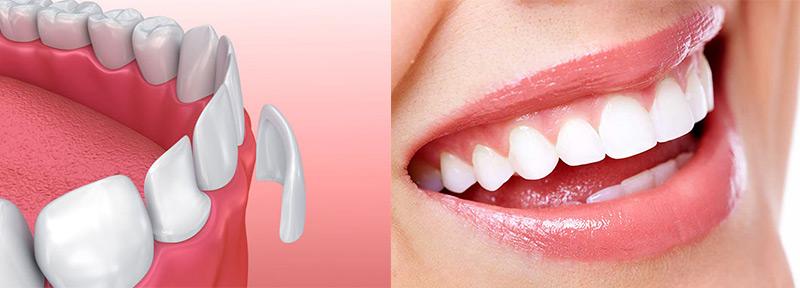 Установка ультратонких виниров в Харькове Установка ультратонких виниров в Харькове